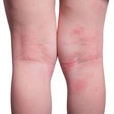 Helping to heal Eczema